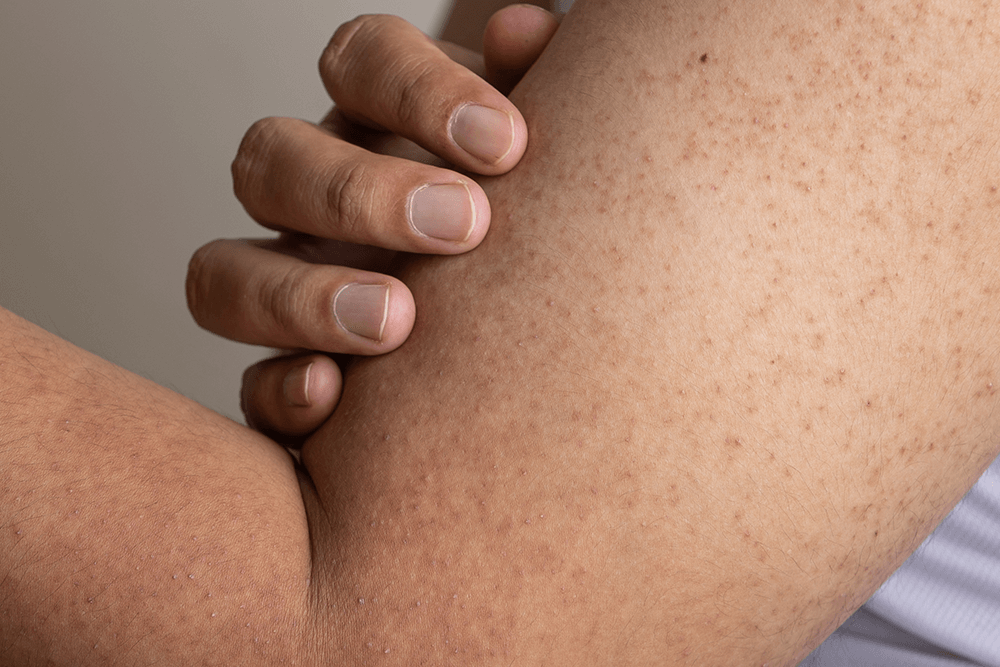 Keratosis Pilaris 101: What is Keratosis Pilaris & How to Treat It