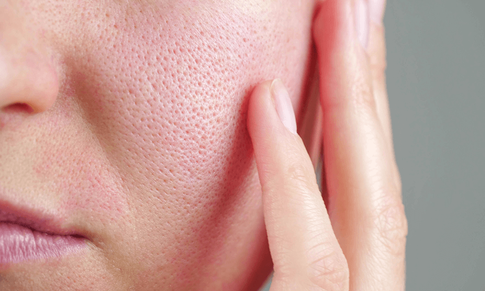 Post peel skin redness