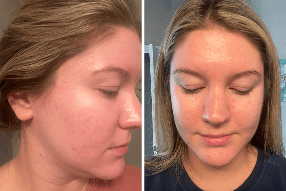 Skincare Success Story: Dull Pores to Even Skin
