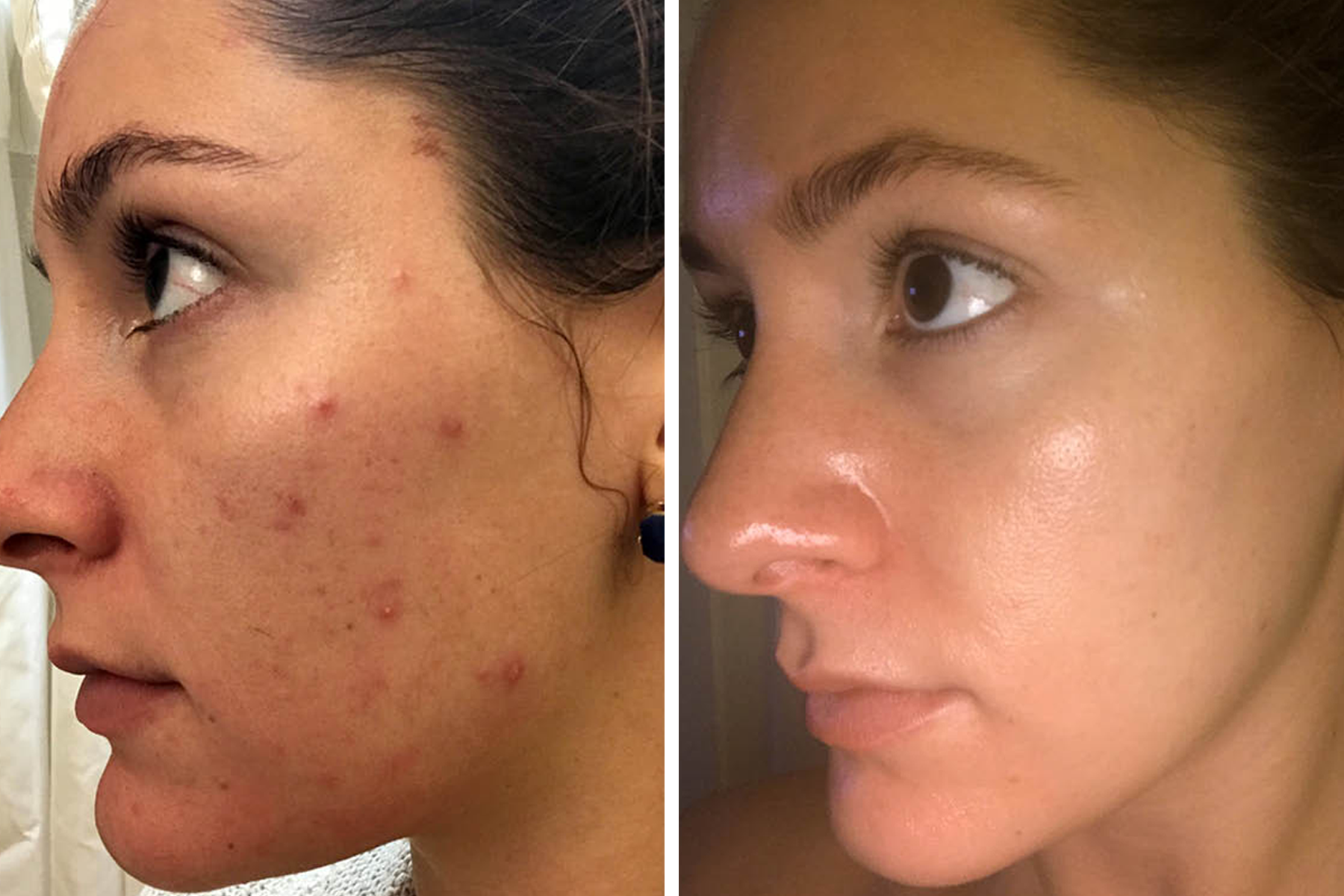 Skincare Success Story: From Acne Woes To Skin That Glows