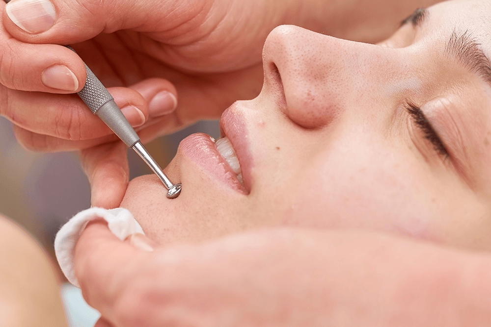 How To Remove Blackheads
