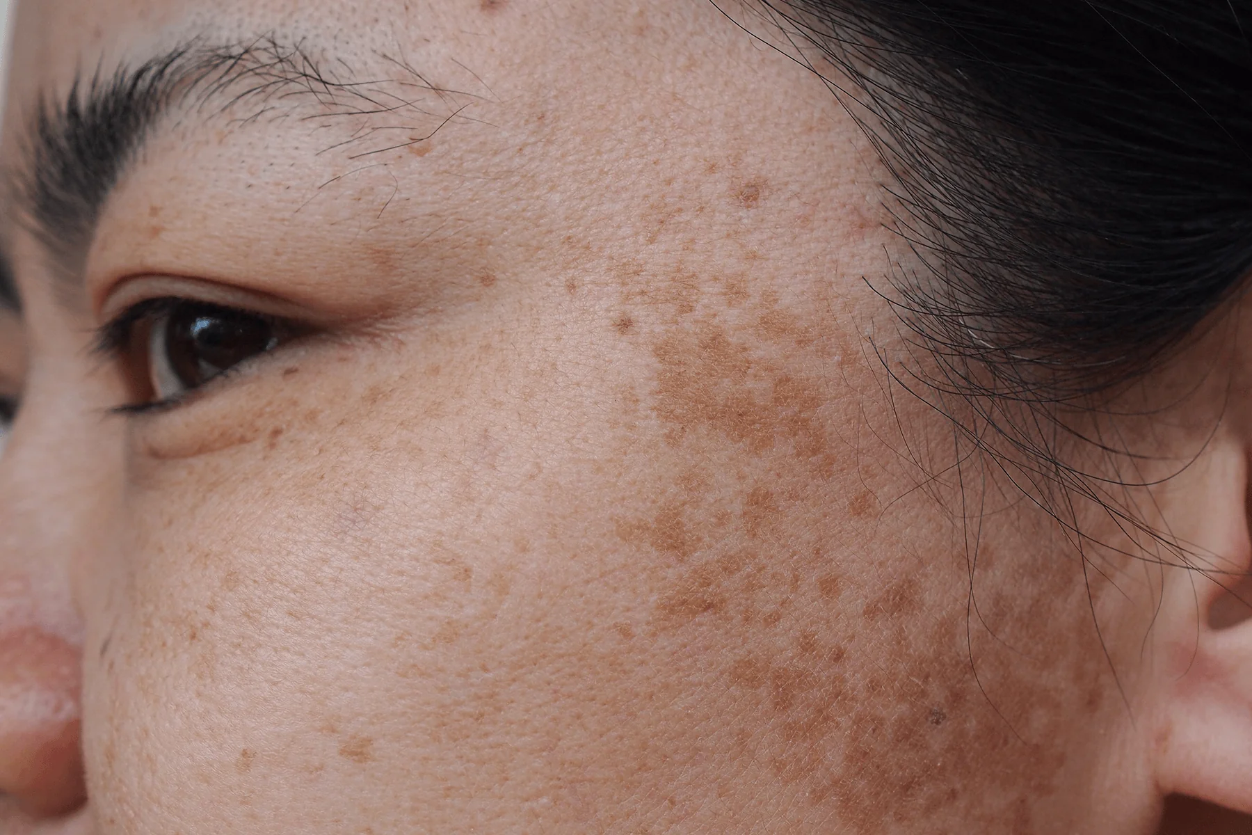 Your Everything Guide to Melasma: What is Melasma, Treatment & Prevention