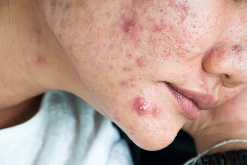 What is Cystic Acne & How to Treat It