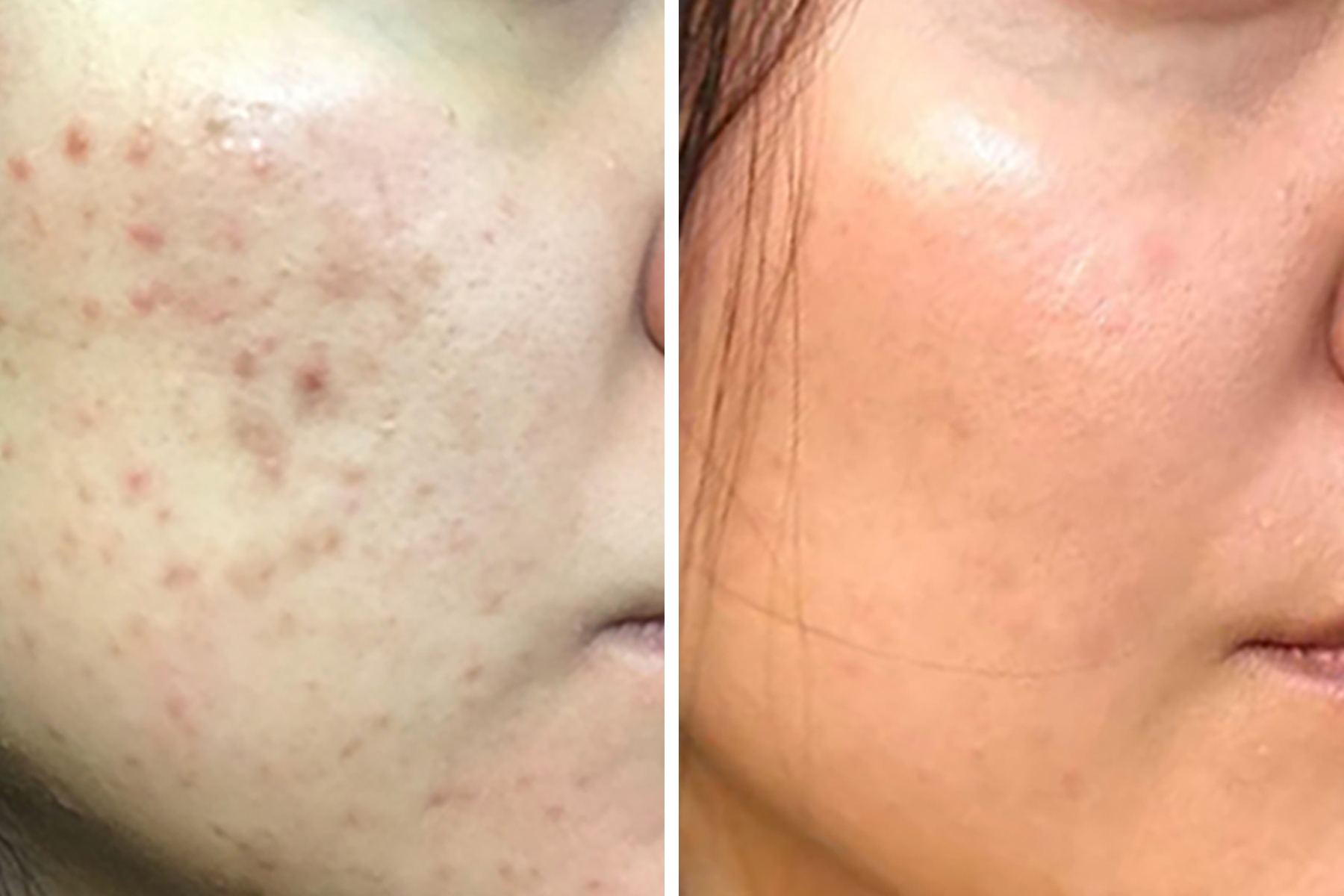 Skincare Success Story: From Clogged & Congested to Clear & Controlled