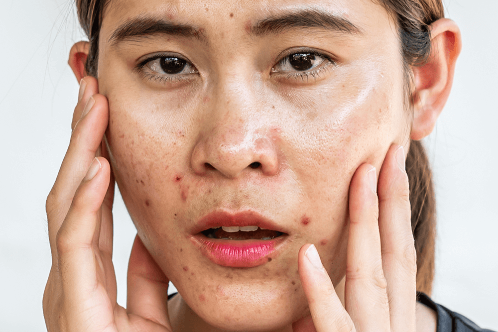 Retinol Purging: The Good, The Bad, And The Uglies