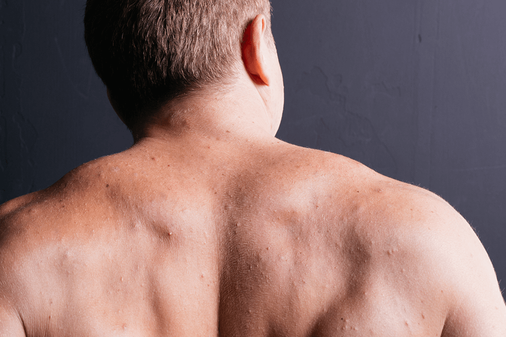 Skincare Tips for Body Acne & How to Get Rid of Body Acne