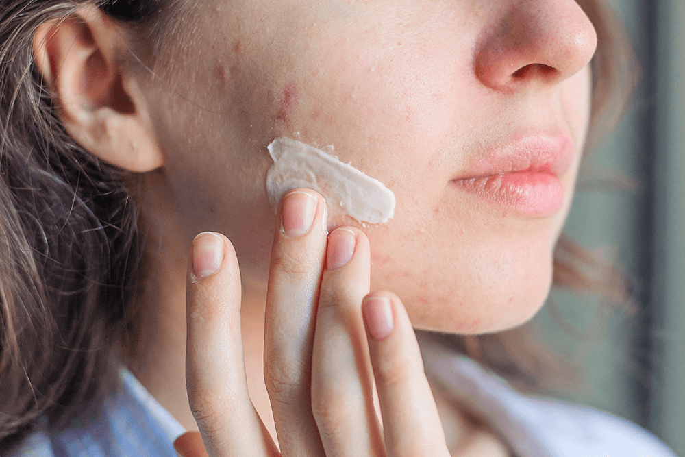 Toothpaste Is Not A Pimple Treatment