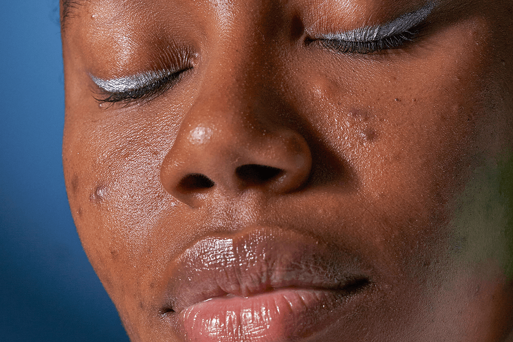 Spotted: The Six Types Of Acne And How To Treat Them