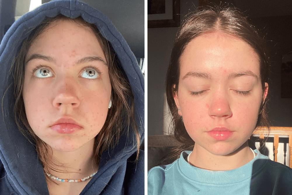 Skincare Success Story: Journey to clear, radiant skin with AHAs & BHAs