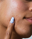 On the Spot Eliminator 2% Salicylic Acid Acne Treatment Gel Video thumbnail number 1